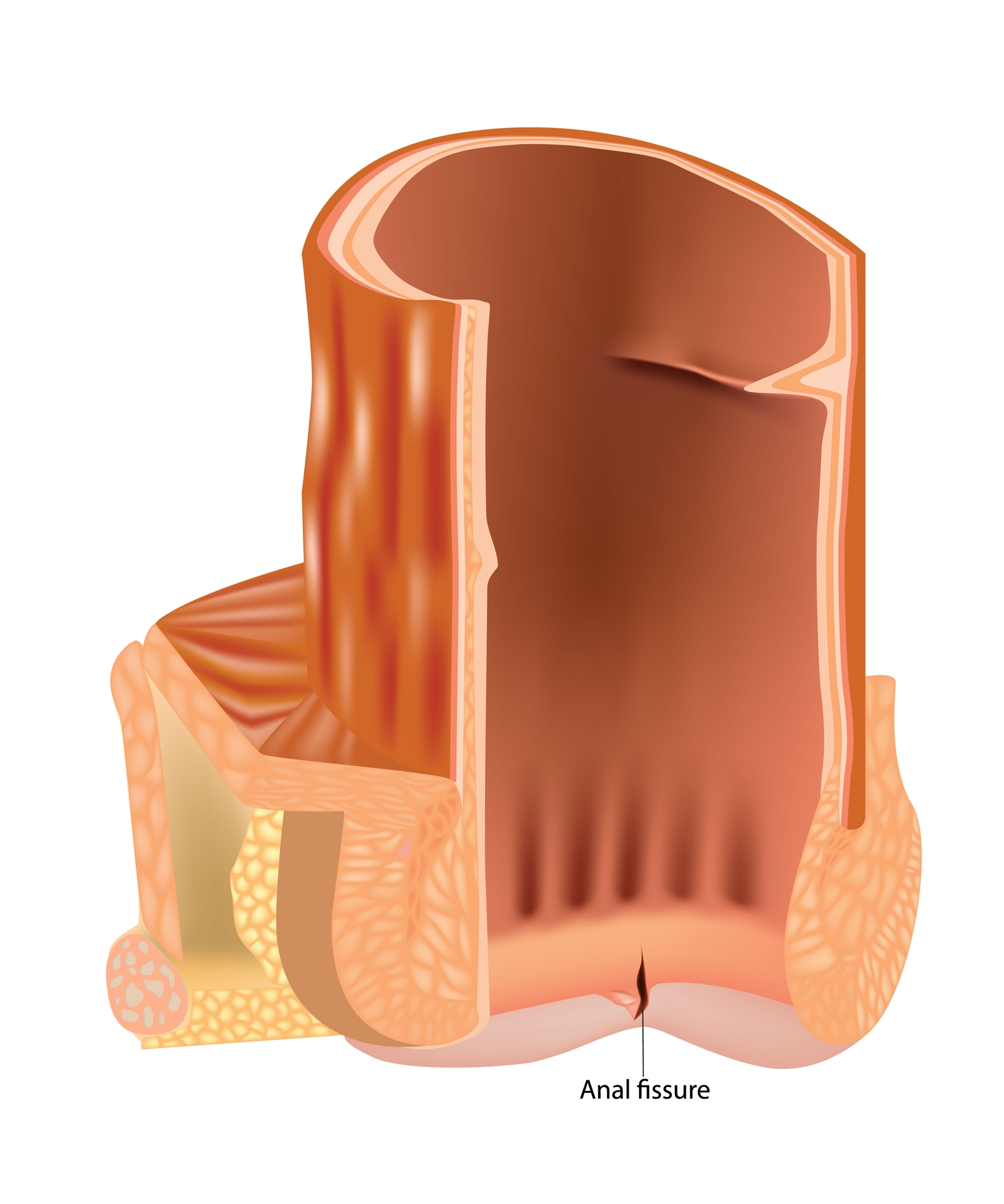 Anal fissure surgery medical illustration