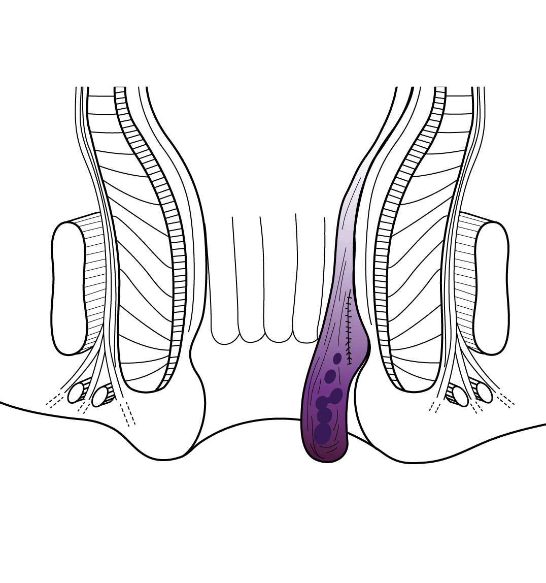 Hemorrhoid surgery medical illustration