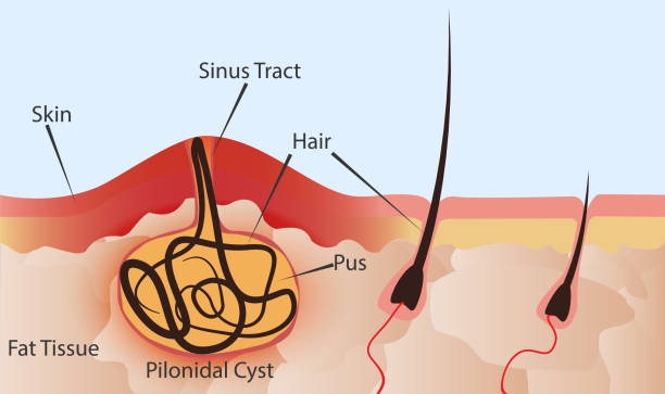 Pilonidal Cyst