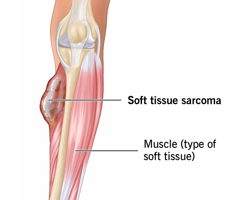 Soft Tissue Tumour